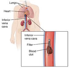 Coronal section of inferior vena cava showing IVC filter in place catching embolus. Locator shows body outline with heart, kidneys, inferior vena cava, and box to show location of filter. SOURCE: 6C11844, also used in 60146A locator from 4A11872 1. Merck Manual Home Edition (2003). Deep Vein Thrombosis (DVT). Retrieved from the WWW on 12/1/06 at: http://www.merck.com/mmhe/sec03/ch036/ch036b.html 2. Cleveland Clinic (2006). Disease Management Project: Cardiology: FDA-Approved Inferior Vena Cava Filters. retrieved 1/10/07 at: http://www.clevelandclinicmeded.com/diseasemanagement/cardiology/segments/vt_filters.htm 3) Boston Scientific (2007). Greenfield Vena Cava Filter. retrieved 6/14/07 at: http://www.bostonscientific.com/med_specialty/deviceDetail.jsp?task=tskBasicDevice.jsp&sectionId=4&relId=3,126,127,128&deviceId=12003 4) Locator: http://www.the-hospitalist.org/details/article/574163/When_Should_an_IVC_Filter_Be_Used_to_Treat_a_DVT.html
